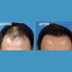 Hair loss